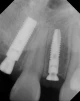 OsseoSpeed S (3.0) - 4